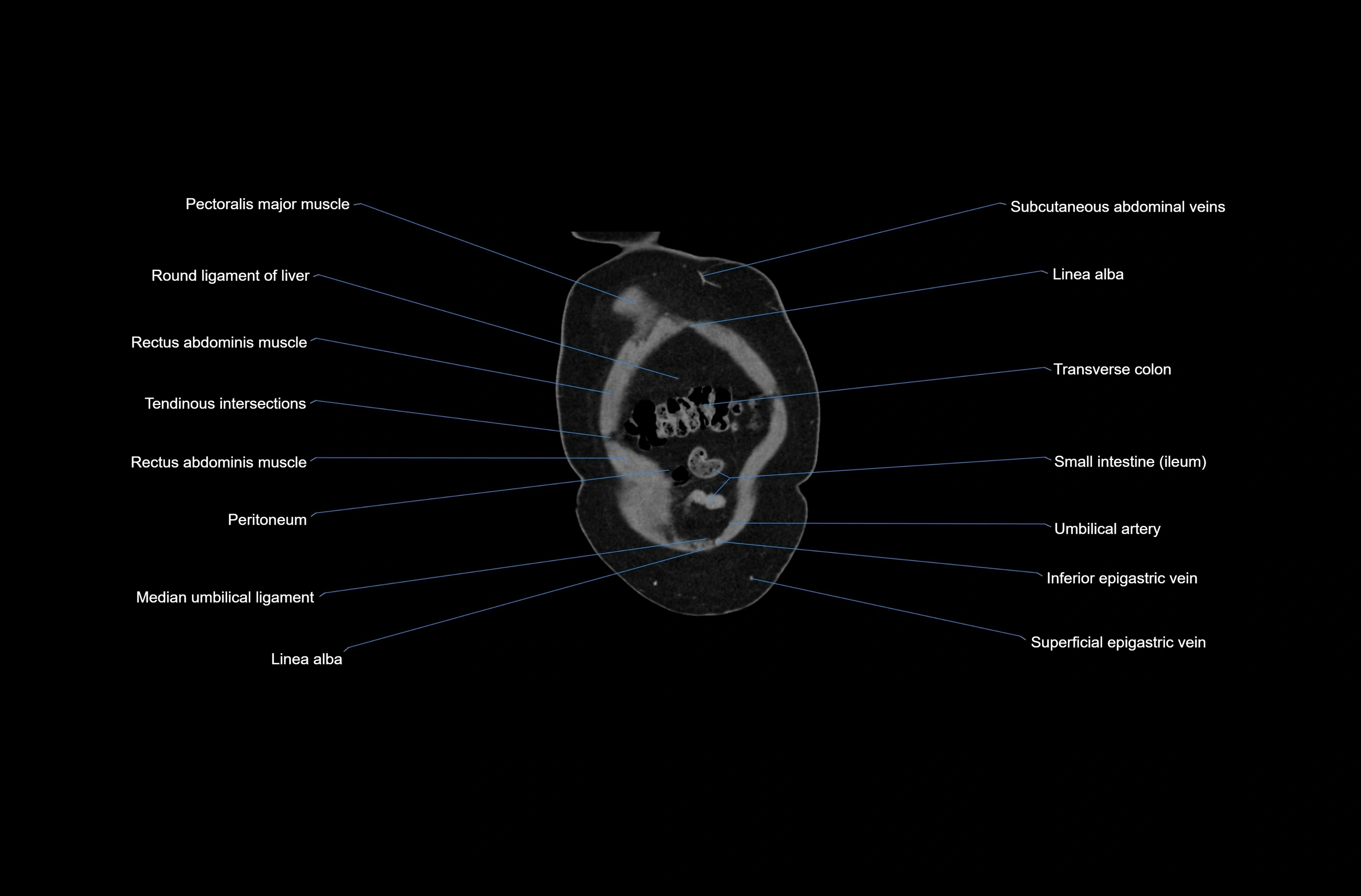 CT abdomen coronal cross sectional anatomy labelled radiology image-00008.webp